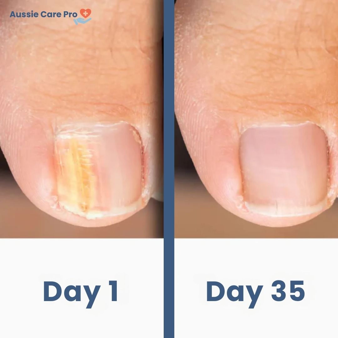 Laser-Gerät zur Nagelpilzbehandlung – sichere und schmerzfreie Therapie